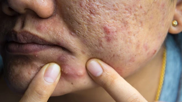 bai-viet/cach-xu-ly-mun-boc-sung-to-an-toan-han-che-tham-seo.html