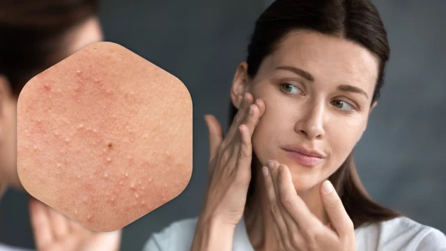 bai-viet/mun-cam-co-nhung-loai-nao-dac-diem-va-cach-dieu-tri.html