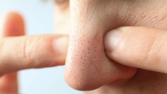 bai-viet/nguyen-nhan-cach-dieu-tri-va-phong-ngua-mun-cam-o-mui.html