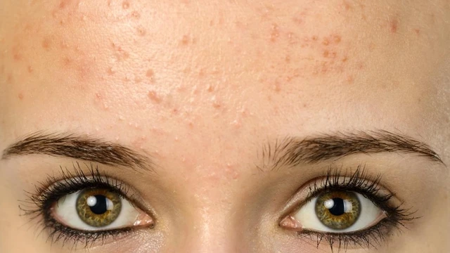 bai-viet/nguyen-nhan-gay-ra-mun-cam-o-tran.html