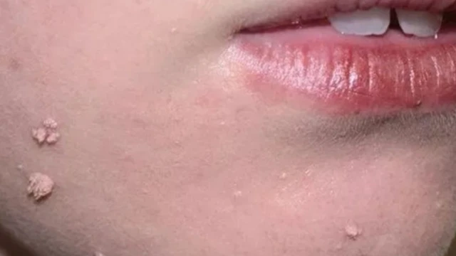 bai-viet/mun-coc-dang-soi-manh-la-gi-phuong-phap-dieu-tri-59641.html