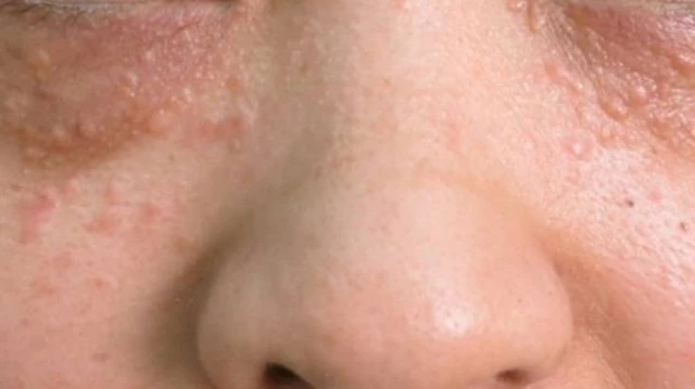 bai-viet/mun-com-o-mat-nguyen-nhan-dau-hieu-va-cach-dieu-tri.html