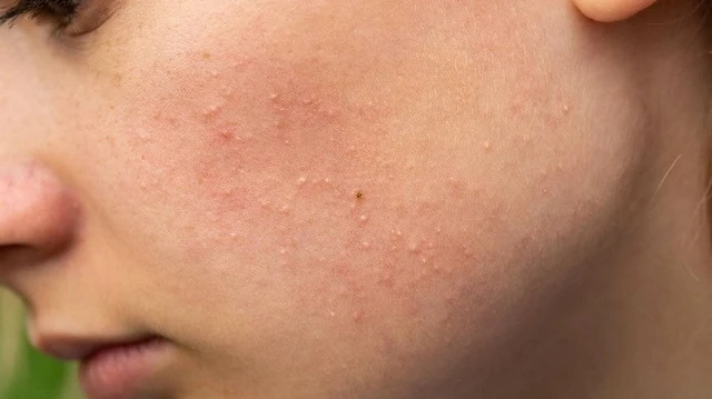 bai-viet/mun-di-ung-my-pham-la-gi-nguyen-nhan-va-cach-phong-tranh.html