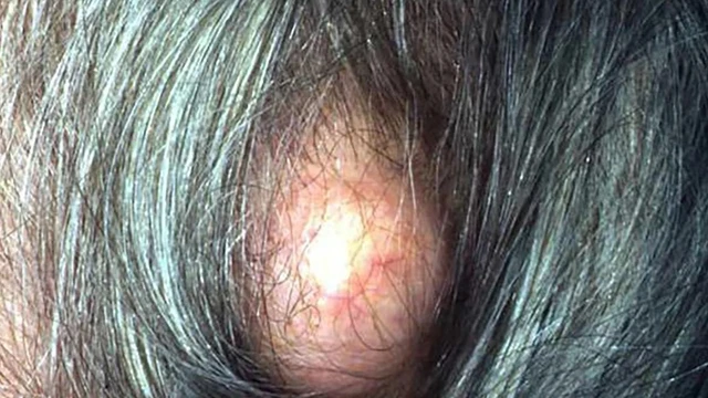 bai-viet/mun-nhot-o-dau-nguyen-nhan-trieu-chung-cach-dieu-tri.html