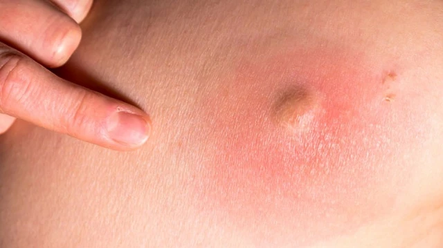 bai-viet/nguyen-nhan-va-cach-dieu-tri-mun-nhot-o-dui.html