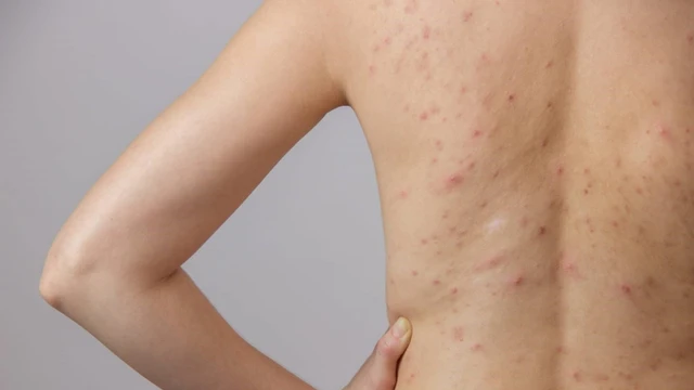 bai-viet/nguyen-nhan-gay-mun-nhot-o-lung-va-cach-dieu-tri.html