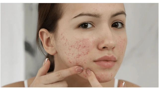 bai-viet/noi-mun-o-ma-nguyen-nhan-do-dau.html