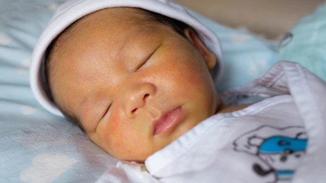 bai-viet/mun-pustular-melanosis-la-gi-nguyen-nhan-va-trieu-chung-cua-mun-pustular-melanosis.html