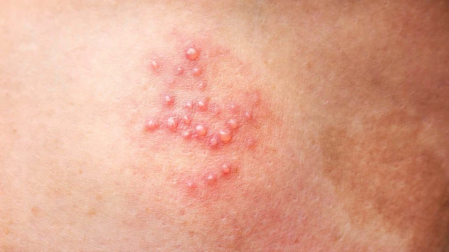 bai-viet/mun-rop-sinh-duc-nam-nguyen-nhan-va-cach-phong-ngua.html