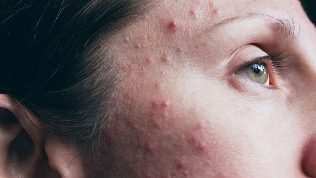 bai-viet/mun-san-la-gi-nguyen-nhan-gay-mun-va-cach-chua-mun-san-hieu-qua.html