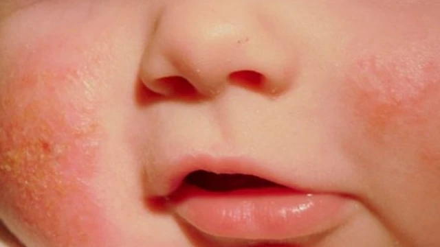 bai-viet/mun-sua-o-tre-so-sinh-va-cach-dieu-tri-59210.html