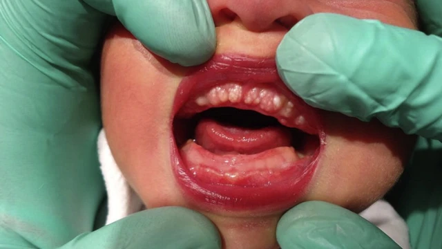 bai-viet/mun-trang-o-loi-tre-so-sinh-nguyen-nhan-va-phuong-phap-dieu-tri.html