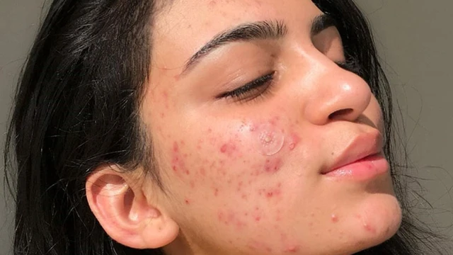 bai-viet/mun-tuoi-day-thi-keo-dai-bao-lau-nhung-dieu-ban-can-biet-ve-mun-tuoi-day-thi-67460.html