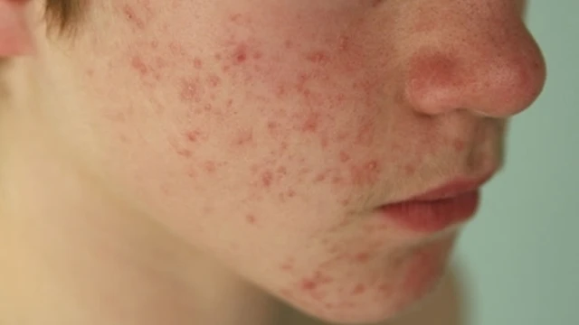 bai-viet/mun-viem-co-tu-het-khong-cach-xu-ly-mun-viem-hieu-qua-va-nhanh-chong.html