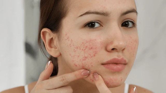 bai-viet/nhung-hoat-chat-dac-tri-mun-hieu-qua-cho-lan-da-cua-ban.html