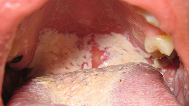 bai-viet/nam-khoang-mieng-la-benh-gi-57082.html