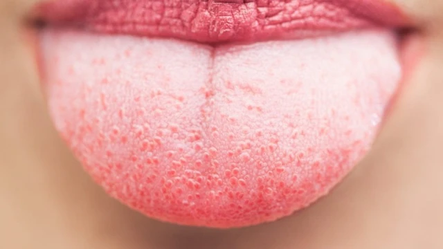 bai-viet/nam-mieng-bi-do-thuong-gap-o-nhung-doi-tuong-nao-56818.html