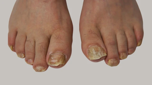 bai-viet/benh-nam-mong-chan-nguyen-nhan-trieu-chung-va-cach-dieu-tri.html