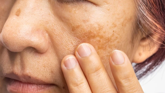 bai-viet/nam-thuong-xuat-hien-o-do-tuoi-nao-cach-phong-ngua-nam-da.html