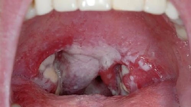 bai-viet/nam-vom-mieng-la-benh-gi-nguyen-nhan-va-cach-dieu-tri-58234.html