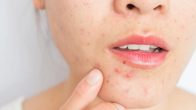 bai-viet/nan-mun-dinh-rau-co-bi-meo-mom-hay-khong.html