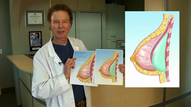 bai-viet/tim-hieu-ve-uu-nhuoc-diem-cua-ky-thuat-nang-nguc-dual-plane.html