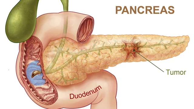 bai-viet/nang-tuy-nguyen-nhan-trieu-chung-chan-doan-va-cach-dieu-tri.html