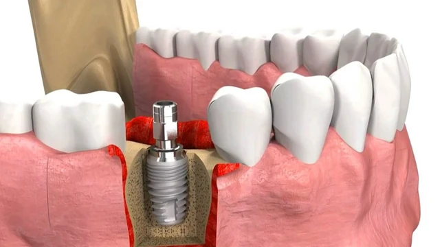 bai-viet/nang-xoang-ho-trong-cay-ghep-implant-co-dau-khong.html