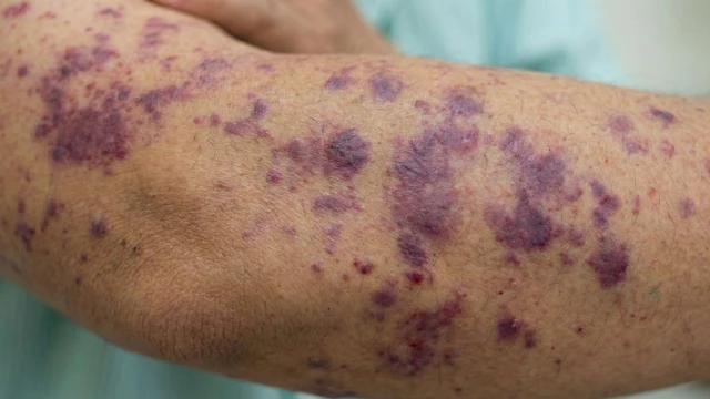 bai-viet/nao-mo-cau-gia-tang-de-nham-cum-tu-vong-nhanh-trong-24-den-48-gio.html