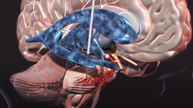 bai-viet/nao-that-la-gi-nhung-dieu-can-biet-co-ban.html