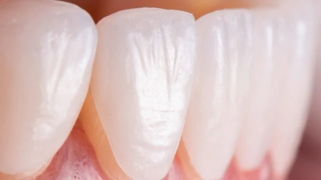 bai-viet/nen-dan-su-veneer-hay-boc-rang-su-cai-nao-tot-hon-63765.html