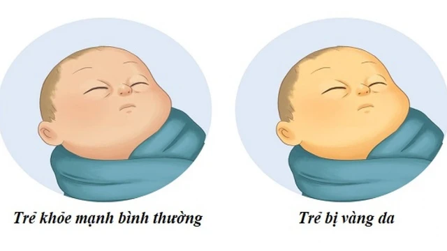 bai-viet/nen-dung-vitamin-d3-cho-tre-so-sinh-vang-da-hay-khong-52430.html