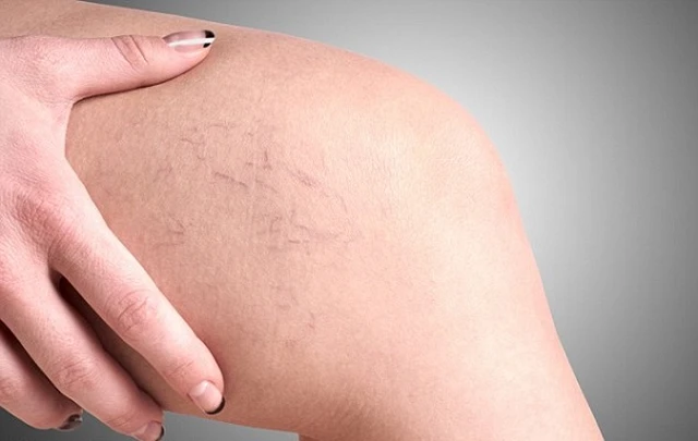 bai-viet/nen-mang-vo-y-khoa-khi-nao-de-ho-tro-dieu-tri-suy-gian-tinh-mach-49161.html