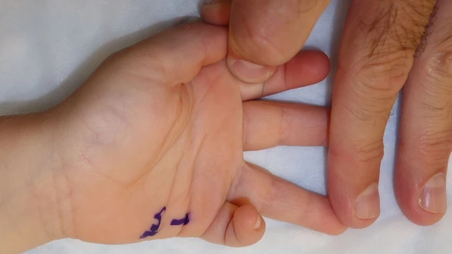 bai-viet/ngon-tay-co-sung-o-tre-em-la-benh-gi-cach-dieu-tri-the-nao.html