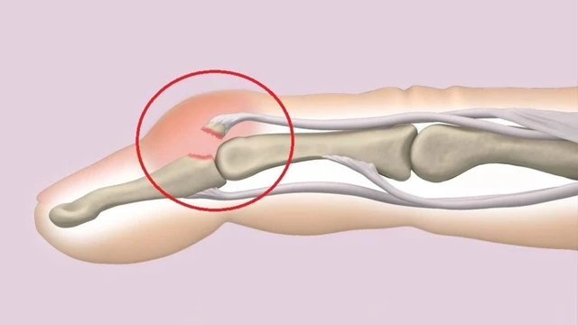 bai-viet/ngon-tay-mallet-co-the-phuc-hoi-binh-thuong-khong.html