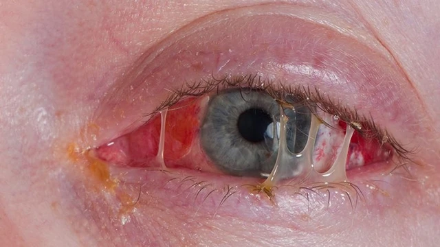 bai-viet/ngu-day-mat-bi-ghen-nhieu-canh-bao-benh-gi.html