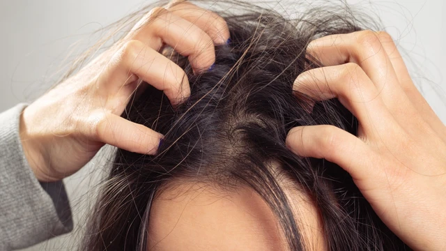 bai-viet/ngua-da-dau-rung-nhieu-toc-nguyen-nhan-va-cach-chua.html