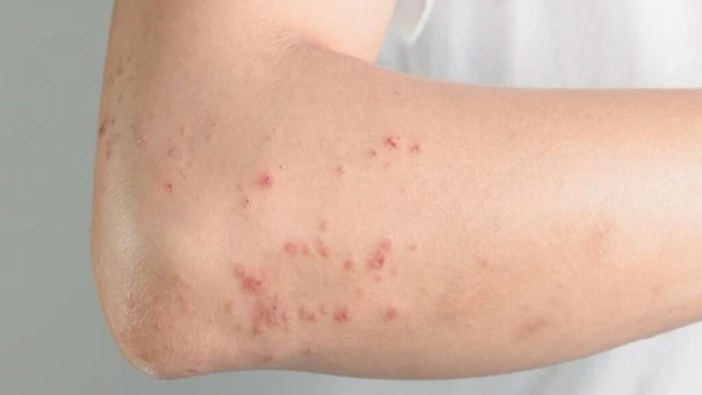 bai-viet/ngua-noi-me-day-toan-than-co-gay-nguy-hiem-hay-khong.html