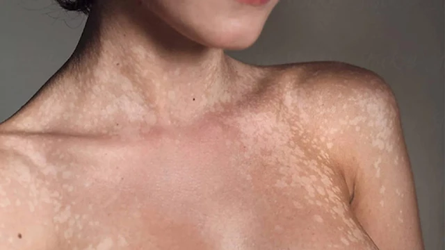 bai-viet/nguyen-nhan-dau-hieu-va-cach-dieu-tri-benh-lang-ben-nau-53452.html