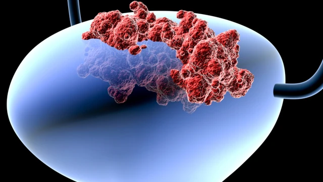 bai-viet/ung-thu-bang-quang-nen-an-gi-nguyen-nhan-gay-benh-ung-thu-bang-quang.html