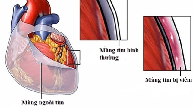 bai-viet/nguyen-nhan-gay-benh-viem-mang-ngoai-tim-co-that.html