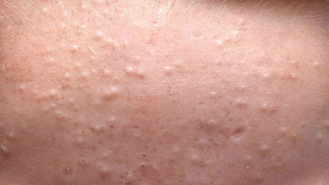 bai-viet/nguyen-nhan-gay-ra-mun-an-la-gi-cach-dieu-tri-mun-an.html