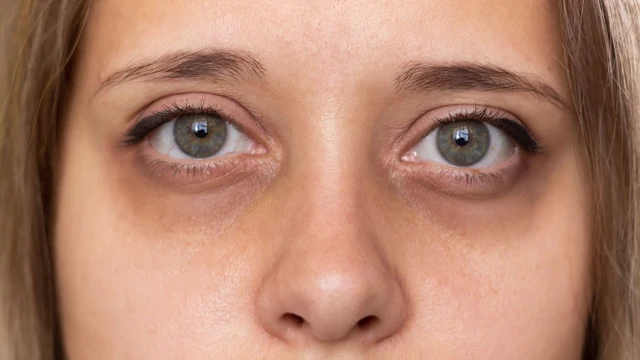 bai-viet/nguyen-nhan-gay-tham-quang-mat-va-cach-khac-phuc-hieu-qua.html