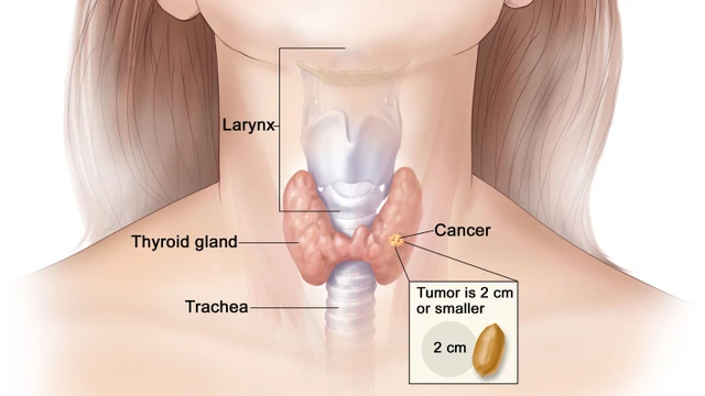 bai-viet/nguyen-nhan-gay-ung-thu-tuyen-giap-54189.html