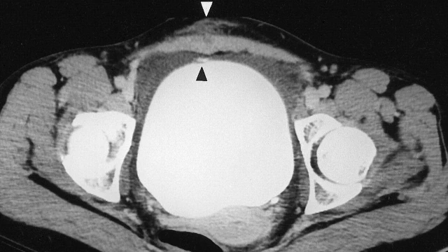 bai-viet/nguyen-nhan-gay-vo-bang-quang-la-gi-va-cach-phong-tranh-nhu-the-nao.html