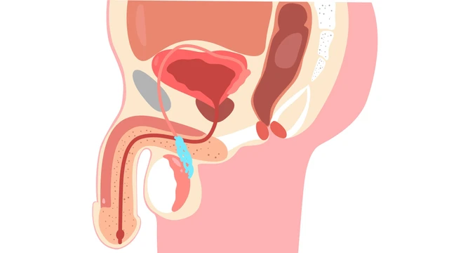 bai-viet/nguyen-nhan-gian-tinh-mach-thung-tinh-la-gi-cach-dieu-tri.html