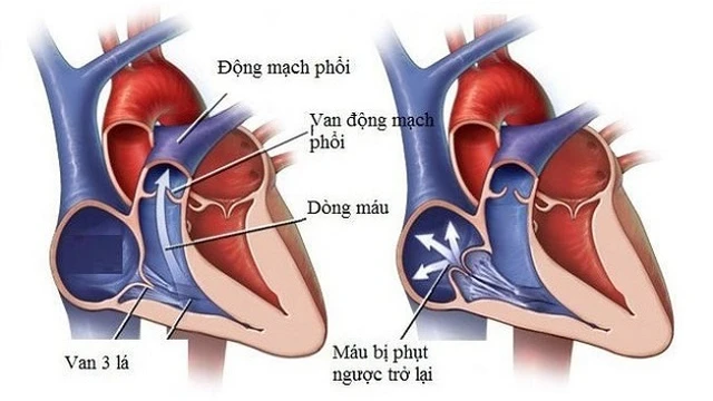 bai-viet/nguyen-nhan-ho-van-tim-la-gi-nguoi-benh-ho-van-tim-3-la-1-4-co-nguy-hiem-khong.html