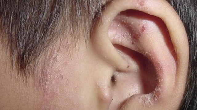 bai-viet/nguyen-nhan-va-cach-ho-tro-tri-hieu-qua-hac-lao-tai-phat-nhieu-lan-55692.html