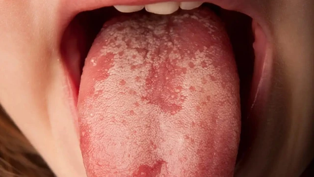 bai-viet/nguyen-nhan-luoi-noi-hat-trang-va-cach-dieu-tri.html