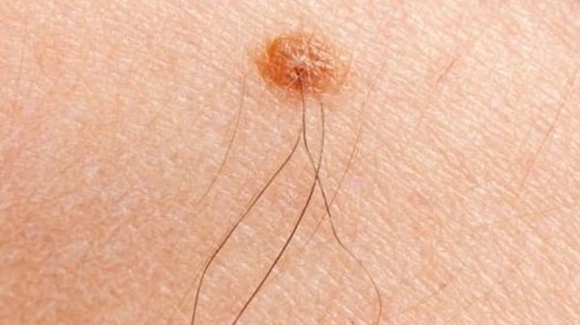 bai-viet/nguyen-nhan-moc-long-o-dau-ti-va-cach-cai-thien-an-toan-63633.html